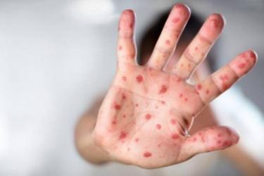 Հայաստանում արձանագրվել է կարմրուկի չորրորդ բերովի դեպքը