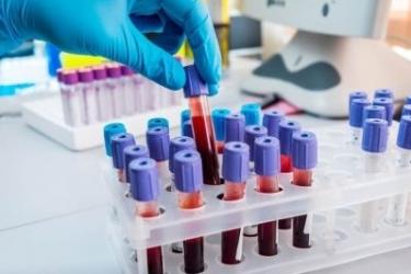 Կորոնավիրուսով վարակման 482 նոր դեպք. կա 11 մահ, որից 4-ն այլ հիվանդությունից