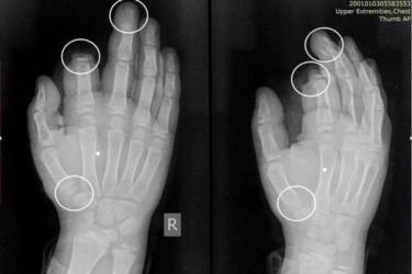 Ամանորի գիշերը պայթուցիկից ստացած վնասվածքից ամպուտացվել է 10-ամյա տղայի մատը 